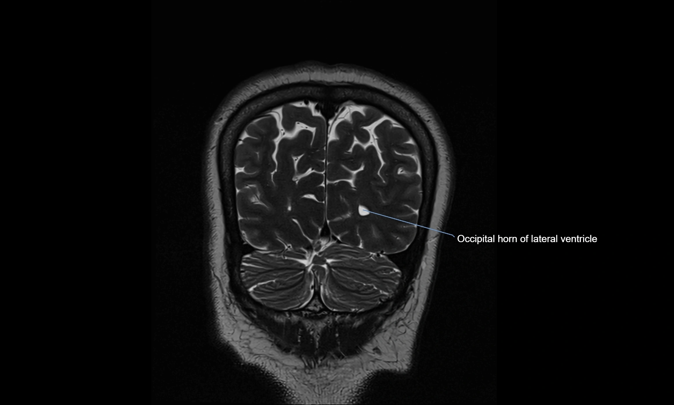 Brain cisterns  and ventricles coronal anatomy 3T MRI image-img-00001-00054.webp